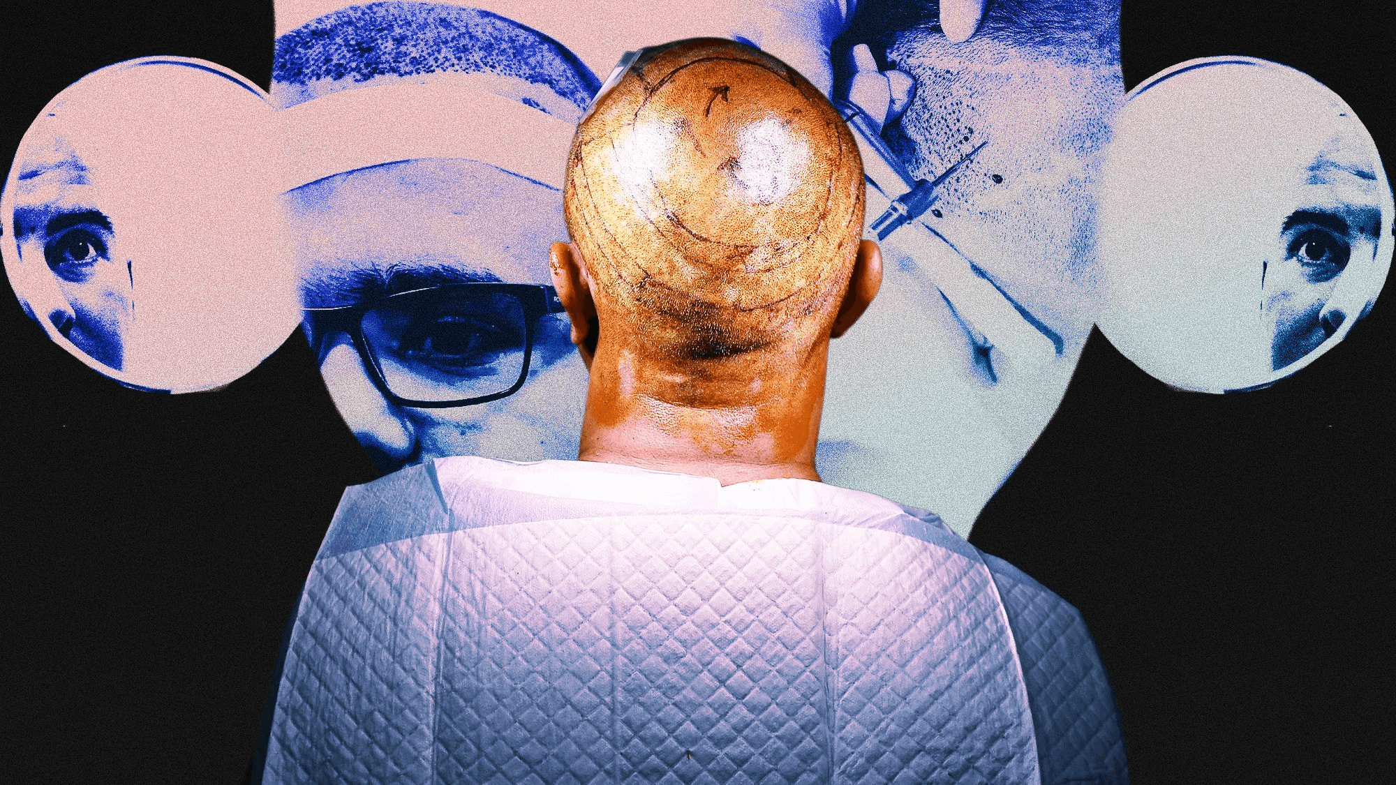 I got a cheap hair transplant in Turkiye, the recovery was agony, and I'd do it again in a heartbeat