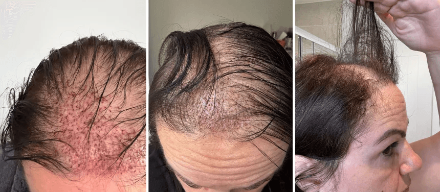 Sam Evans documenting the surgical results that failed to regrow her hair